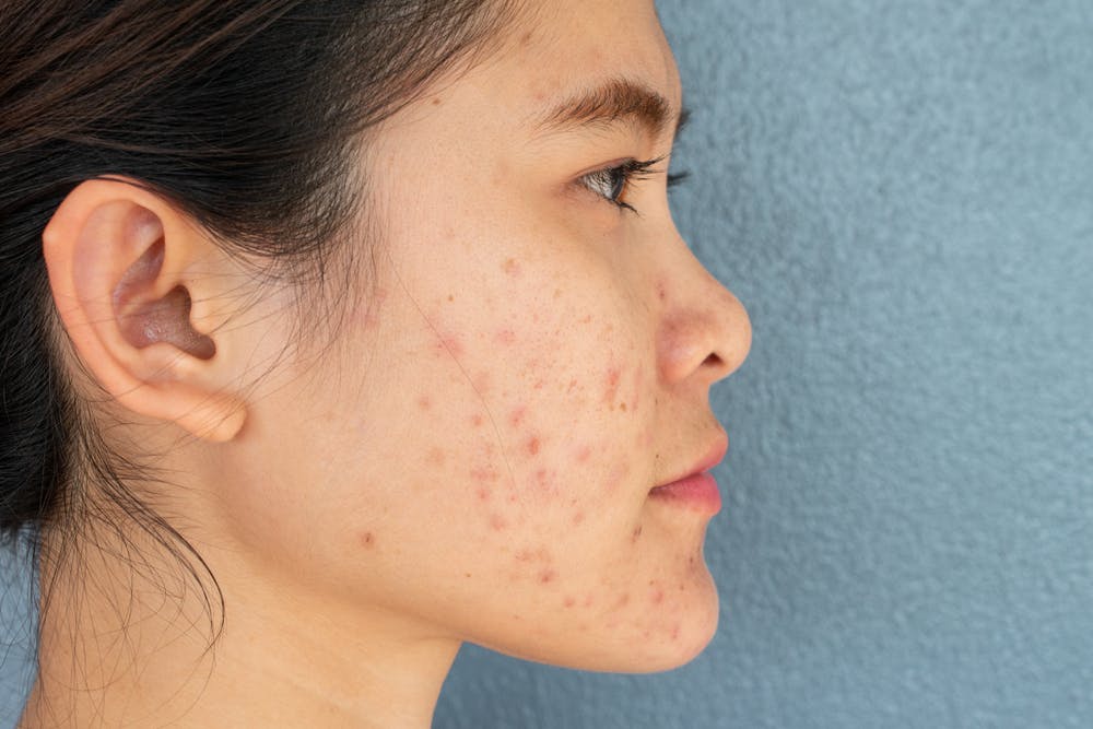 Hormonal acne on cheeks and jawline 