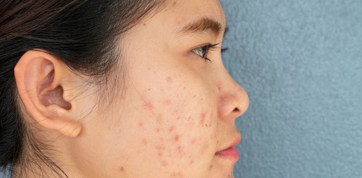 Woman with hormonal acne