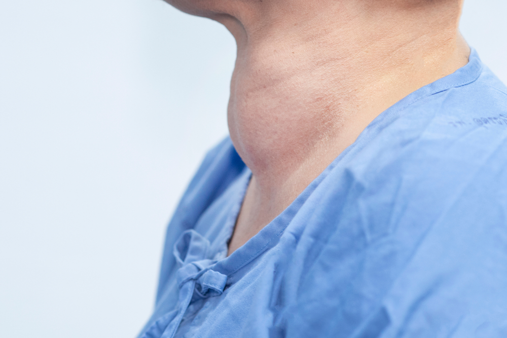 Patient with Hashimoto's thyroiditis goitre swelling on their thyroid gland