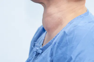 Patient with Hashimoto's thyroiditis goitre swelling on their thyroid gland