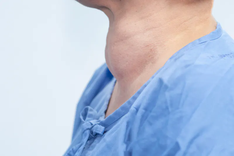 Patient with Hashimoto's thyroiditis goitre swelling on their thyroid gland