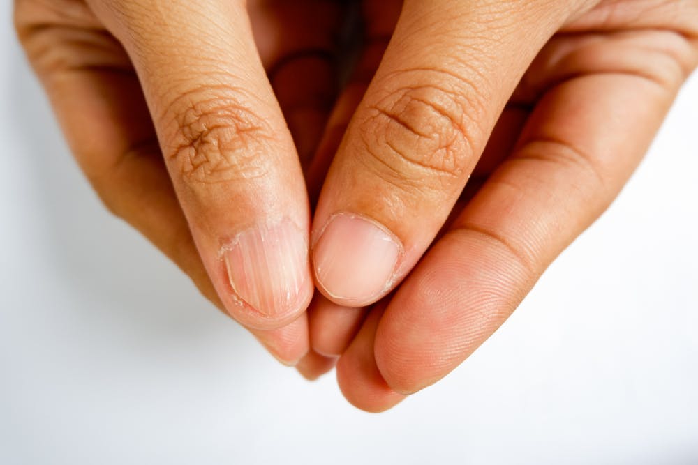 Brittle nails symptom of iron deficiency anaemia