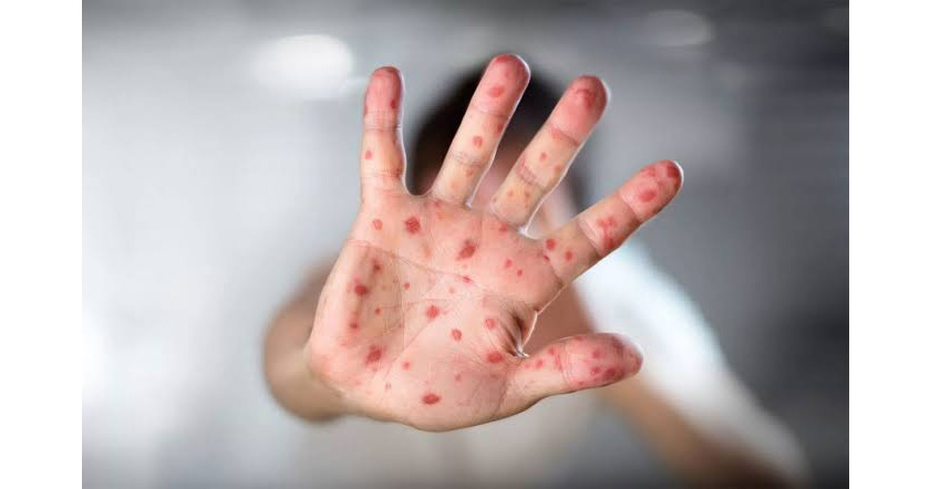 Suriname Health Director Urges Healthcare Workers to Get Measles Vaccine