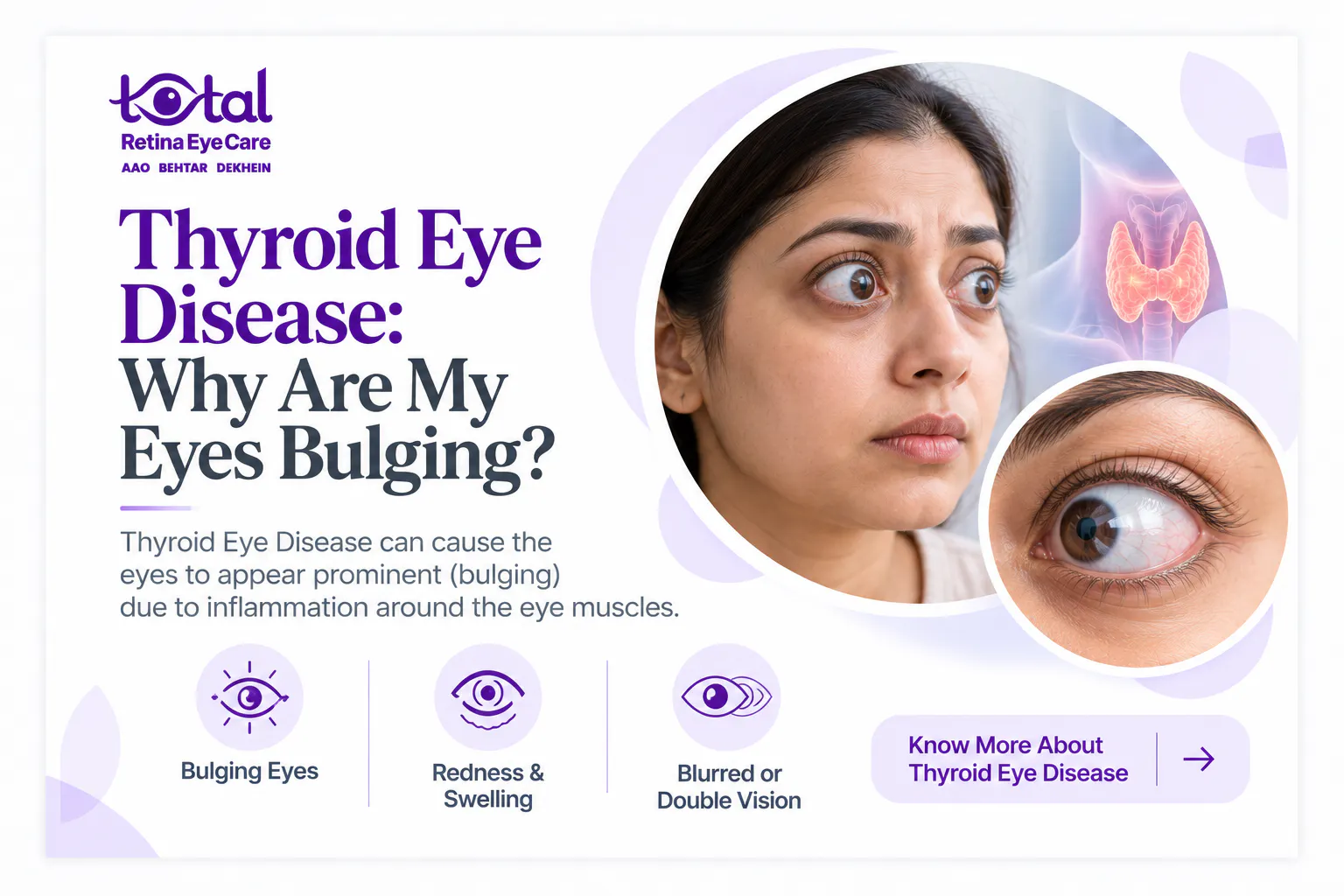 thyroid eyes disease