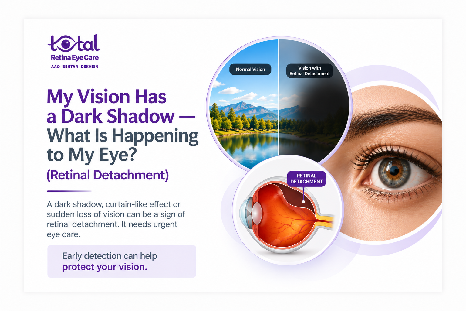 Dark Shadow or Curtain in Vision? Retinal Detachment Symptoms & Causes | Retina Specialist in Nagpur