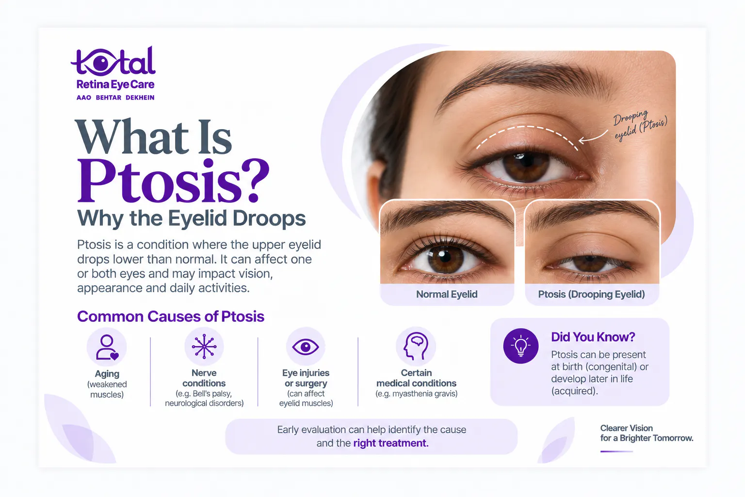 Ptosis (Drooping Eyelid): Causes & Treatment | Nagpur