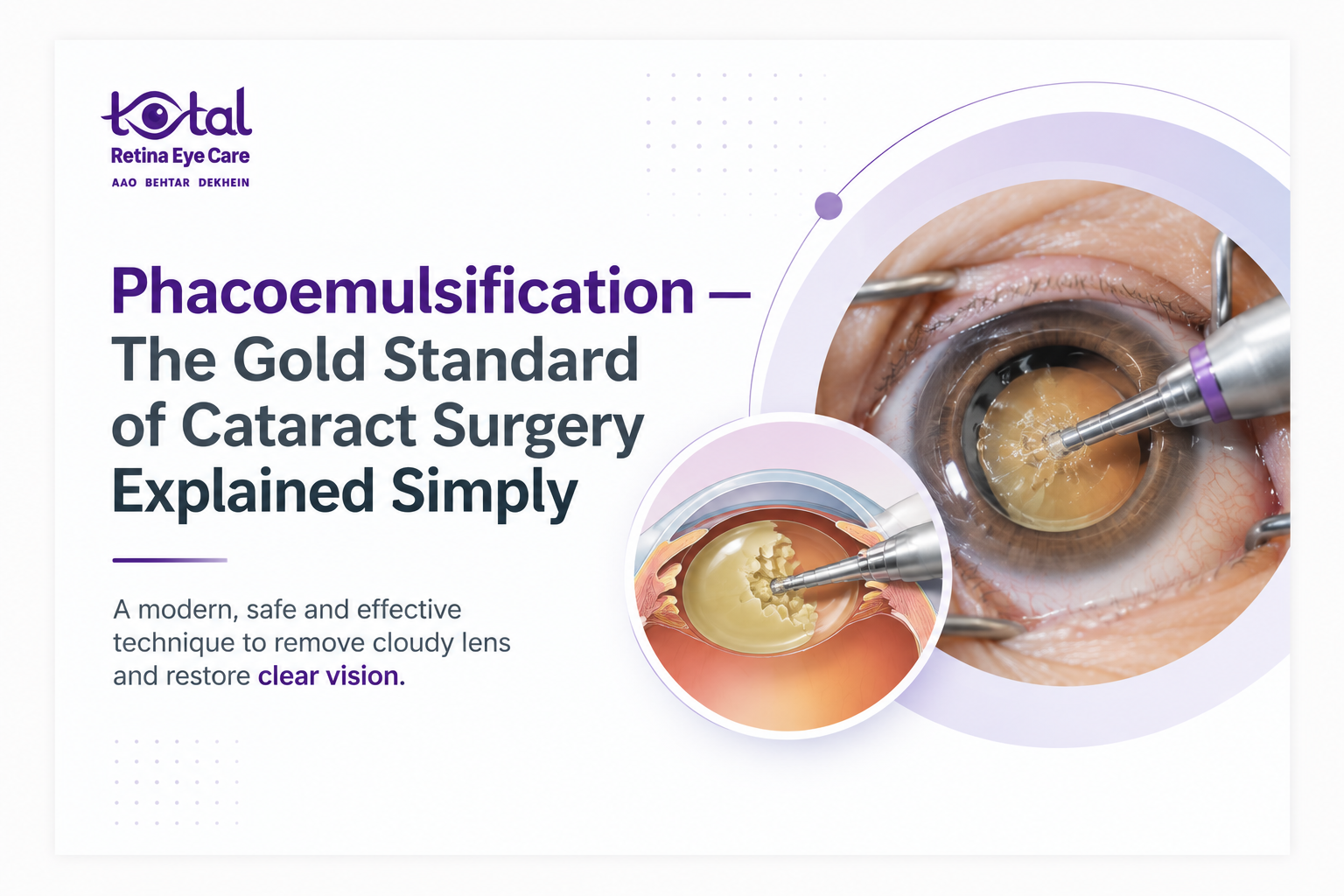 Phacoemulsification: Cataract Surgery Explained Simply Nagpur
