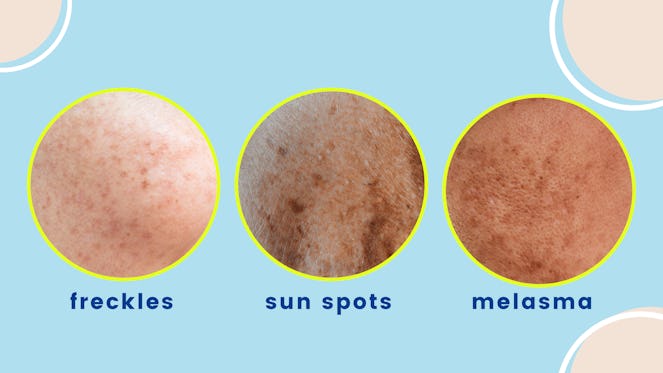 Freckles, Sun spots or Melasma