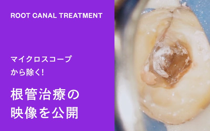 根管治療の映像を公開。マイクロスコープから観た根管治療を解説していきます。(ドクターひろかみんチャンネル)