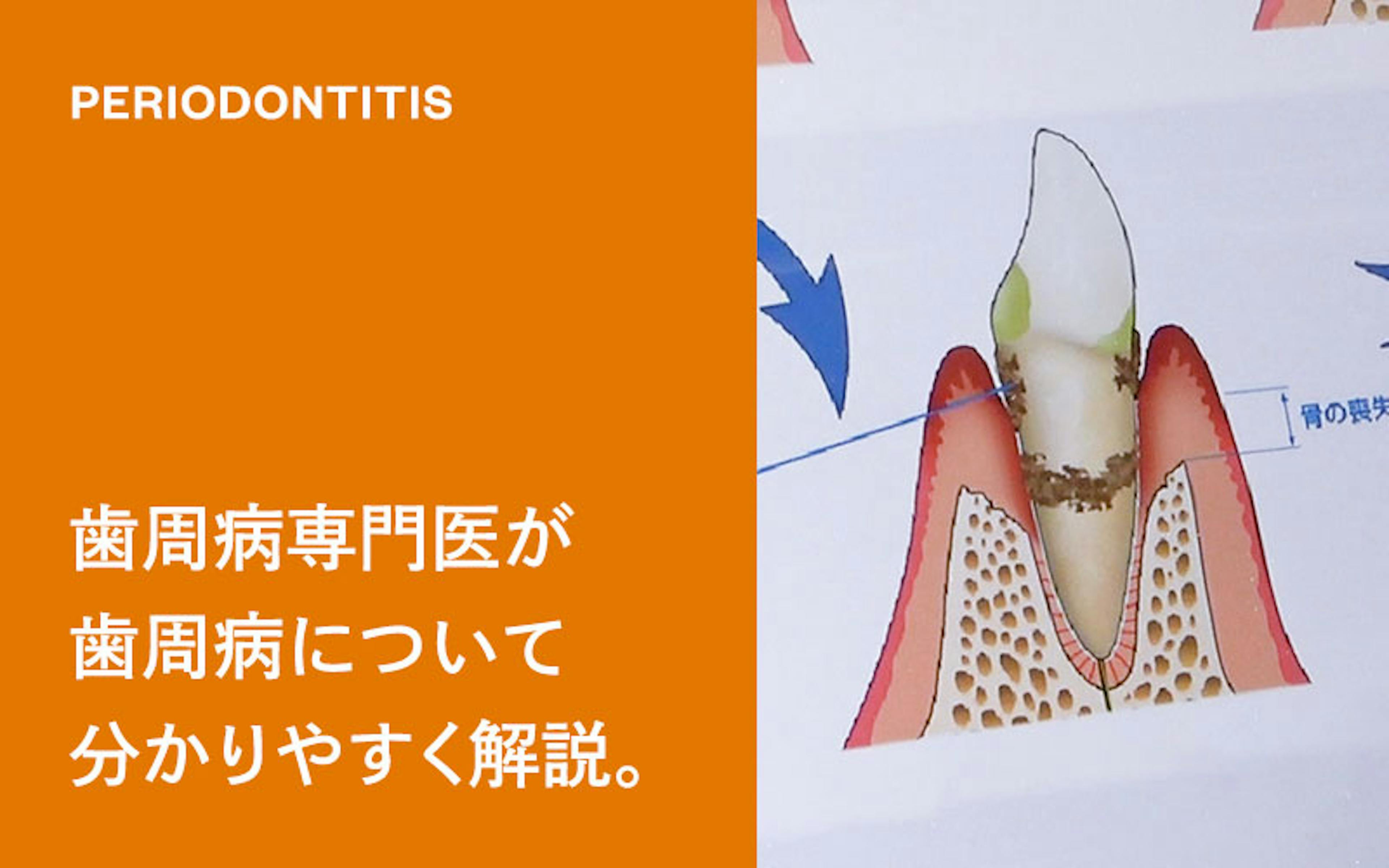 歯がなくなる前に！身近に潜む恐ろしい病気。歯周病専門医が歯周病について分かりやすく解説します。（ドクターひろかみんチャンネル）