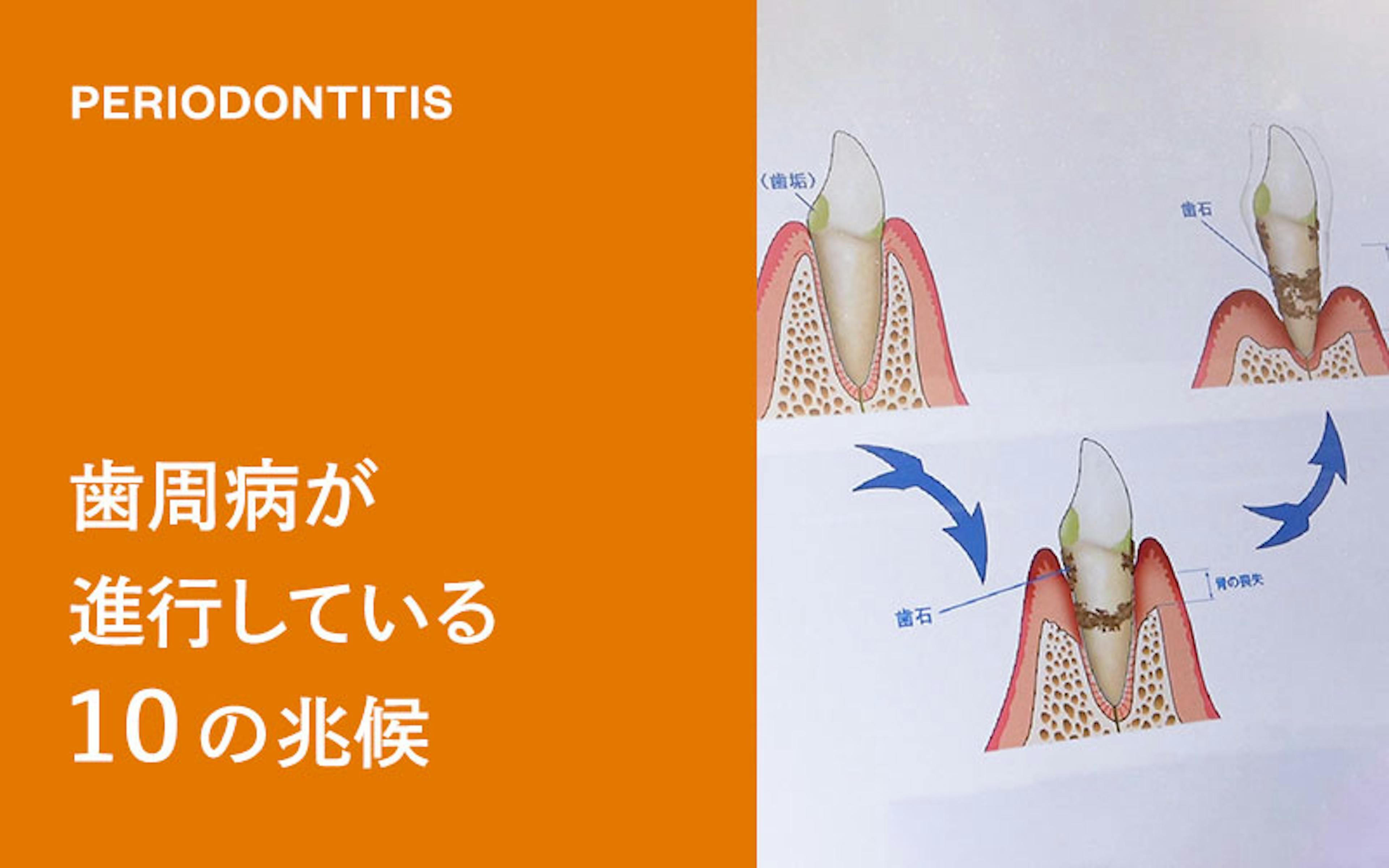 歯周病が進行している10の兆候をお伝えします。（ドクターひろかみんチャンネル）