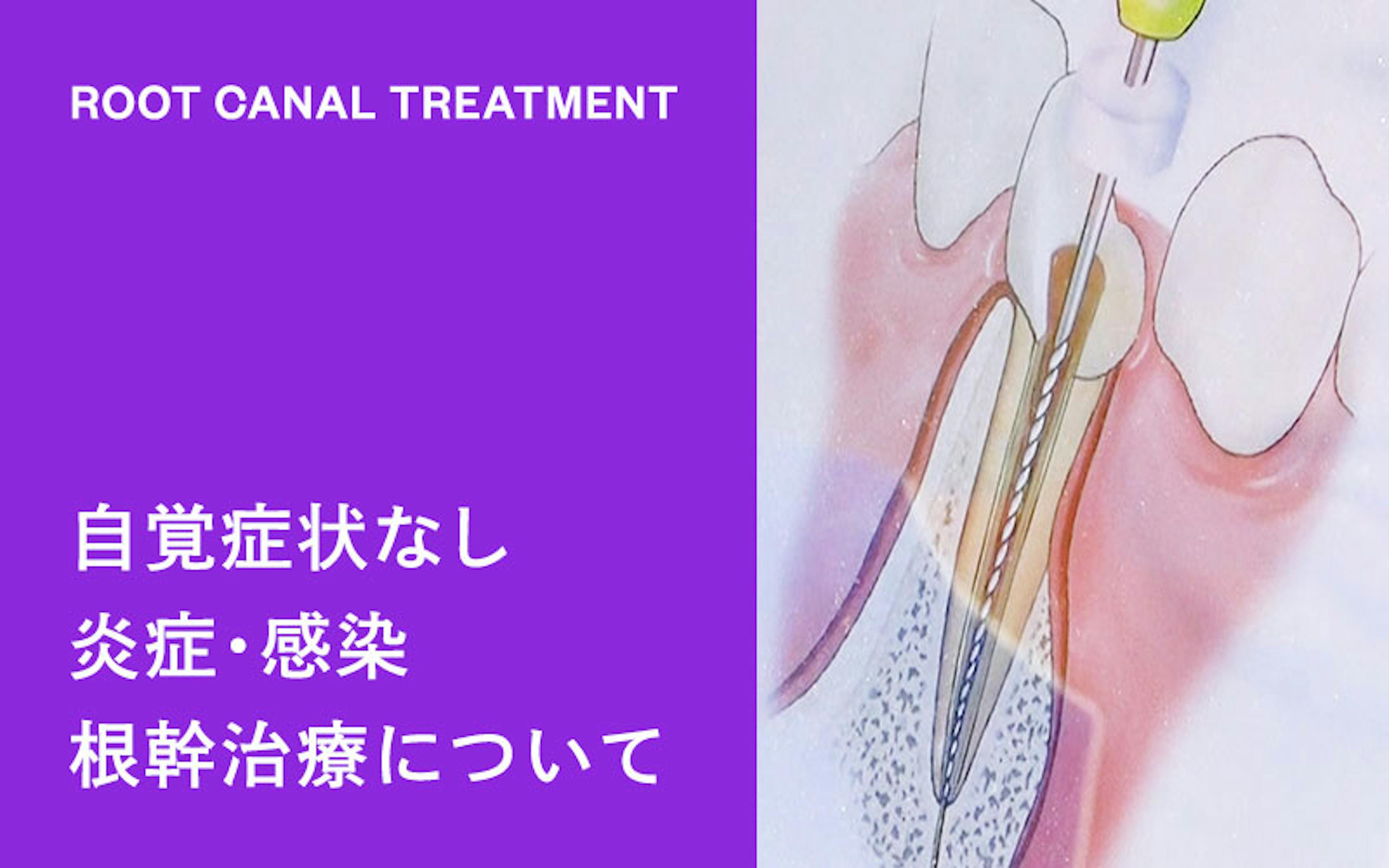 放っておくと怖い根っこの炎症や細菌感染。根管治療について専門医が解説します。（ドクターひろかみんチャンネル）　