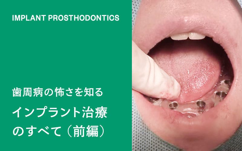 歯周病の怖さを知る。インプラントの治療を全て見せます。前編(ドクターひろかみんチャンネル)