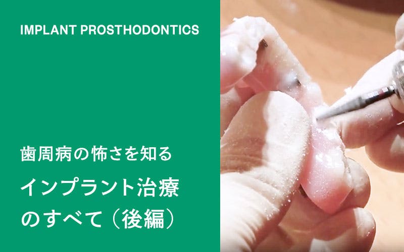 歯周病の怖さを知る。インプラントの治療を全て見せます。後編(ドクターひろかみんチャンネル)