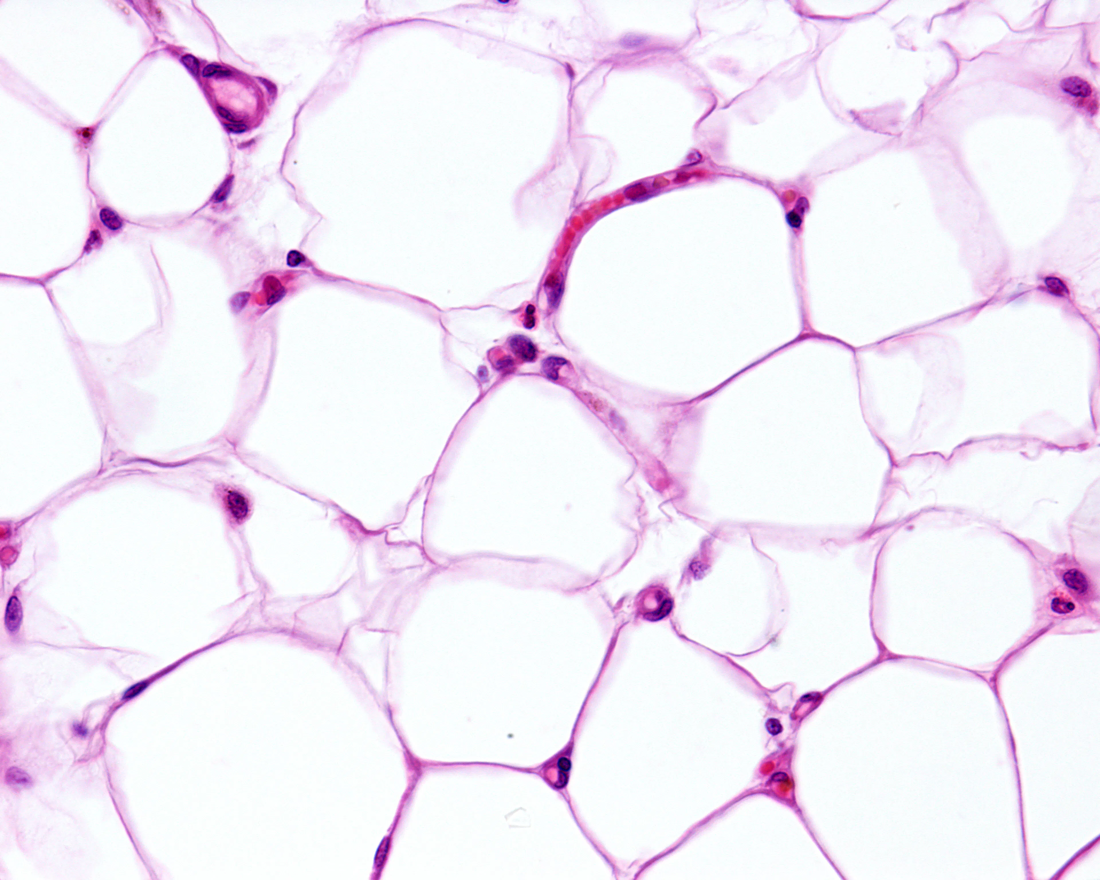 Precision medicine to combat obesity