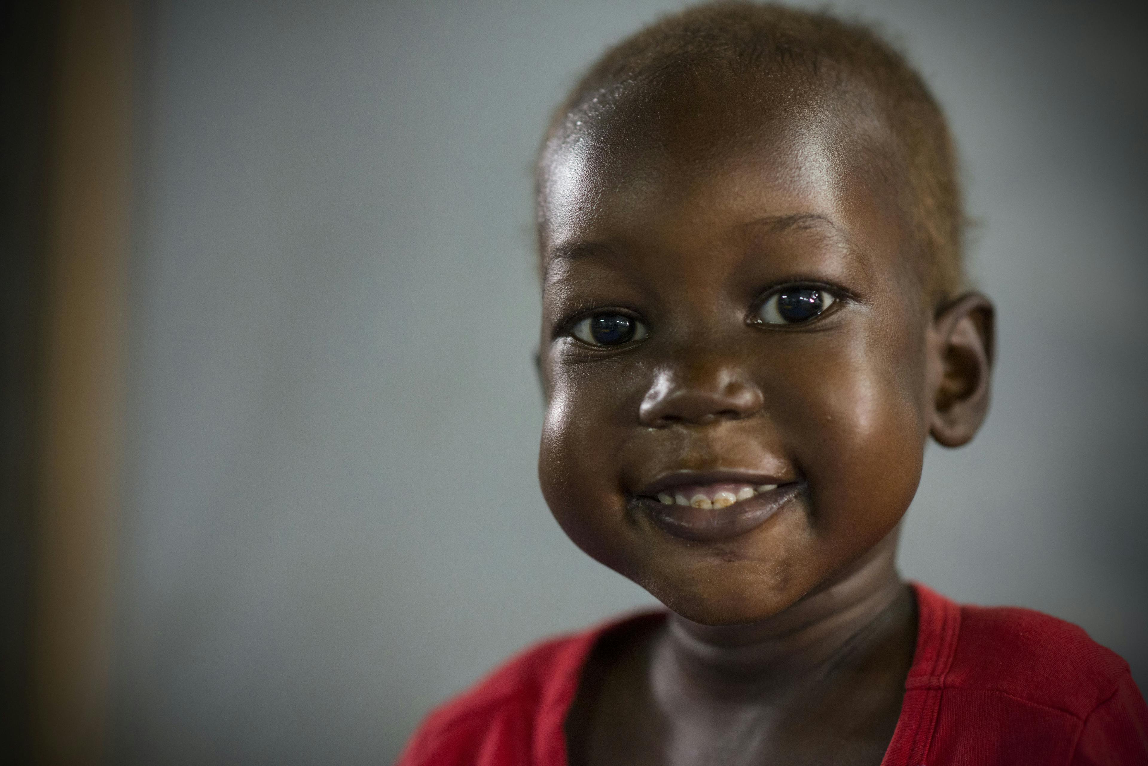Nyajime Guet, 4, who is being treated for severe acute malnutrition