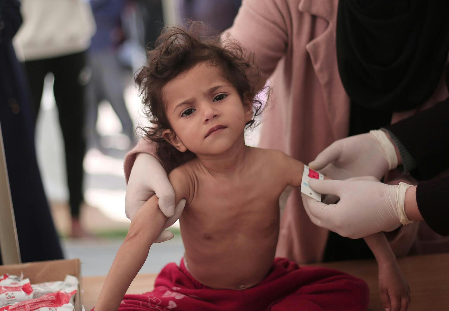 Leen, 2-year-old, middle-upper-arm-circumference reading is dangerously low at less than 10 indicating severe acute malnutrition