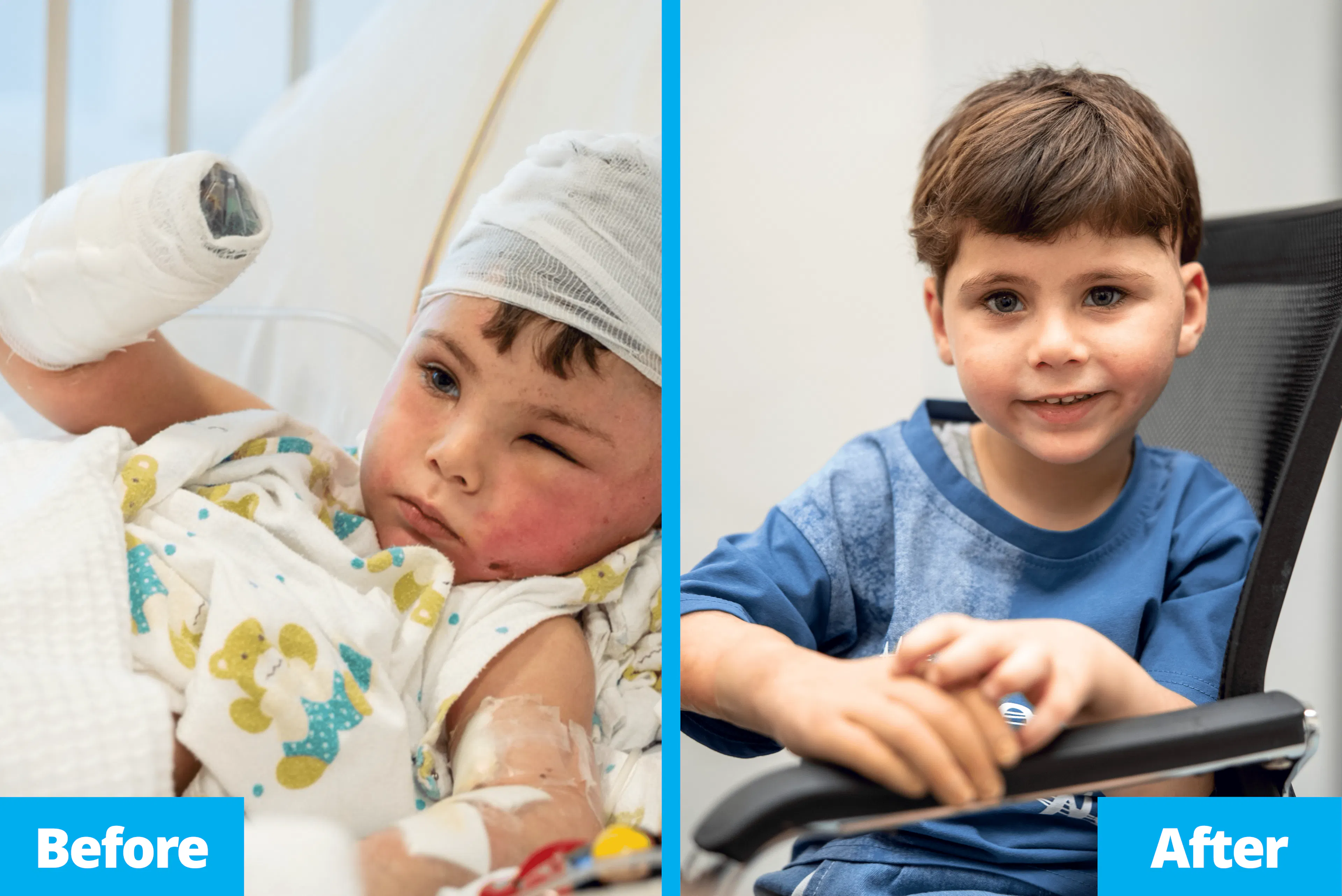 Ali before and after receiving his new prosthesis