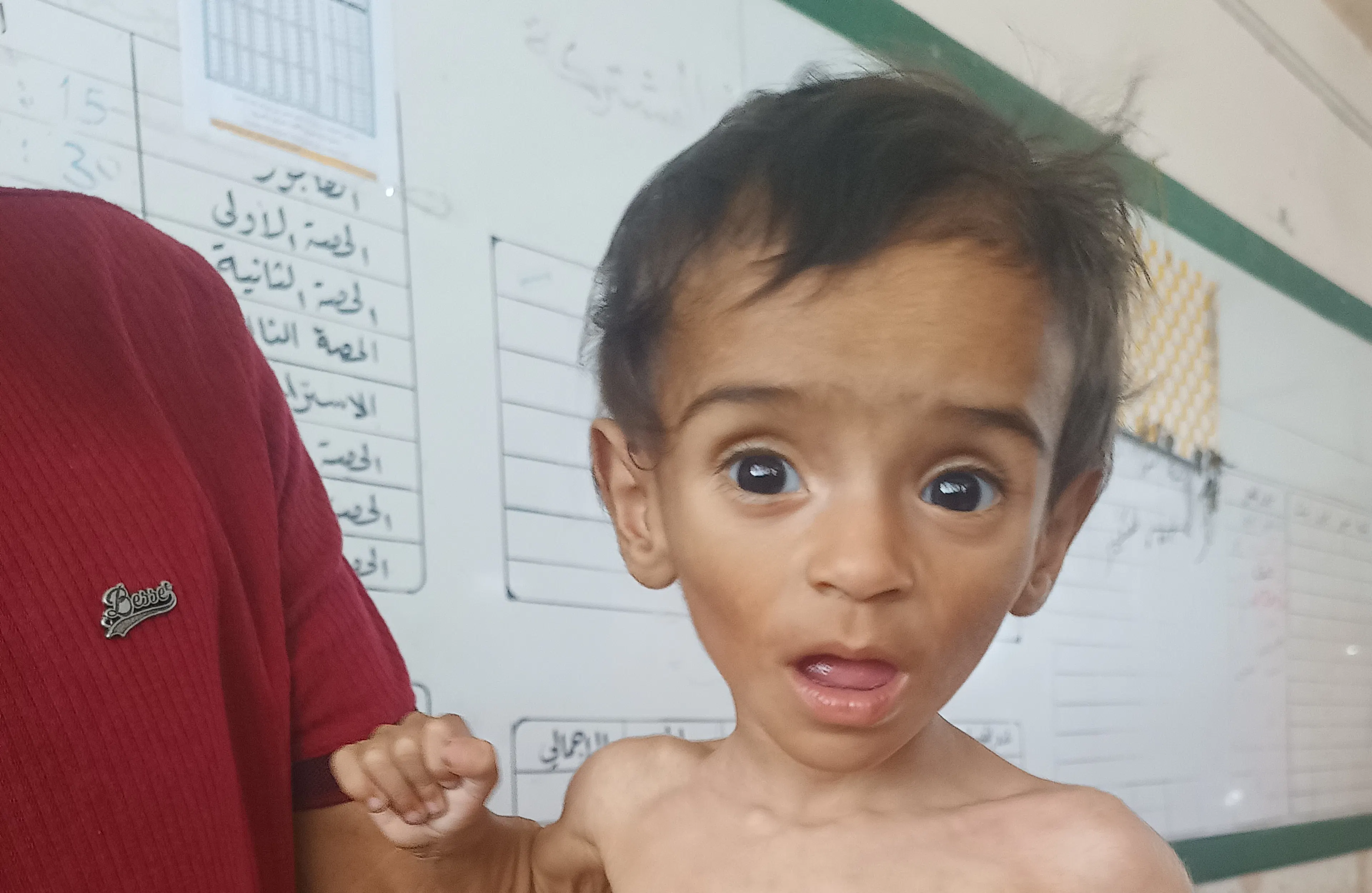 Oday is gaunt and barely able to interact before receiving treatment for Severe Acute Malnutrition.