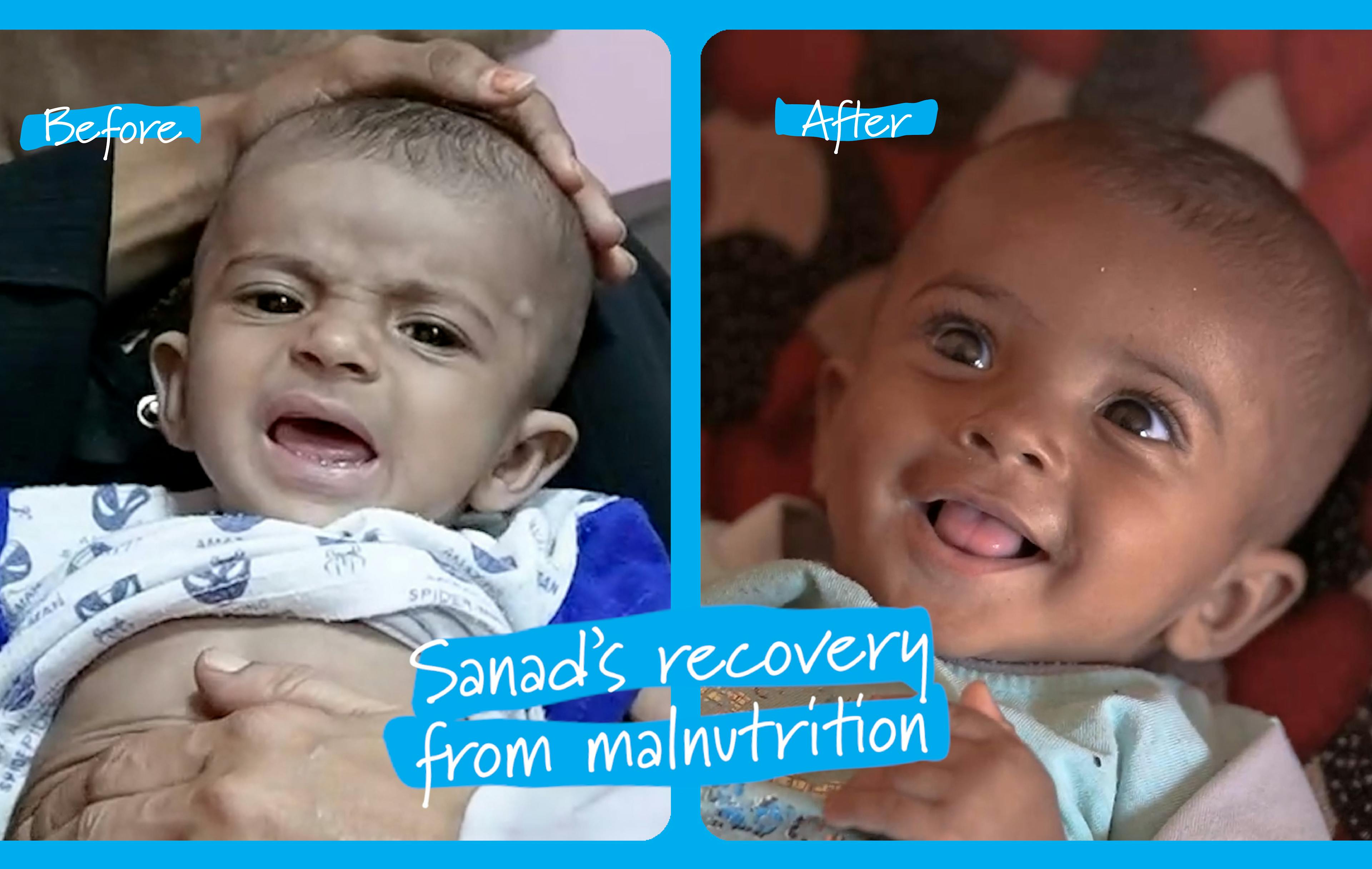 Sanad’s recovery from malnutrition