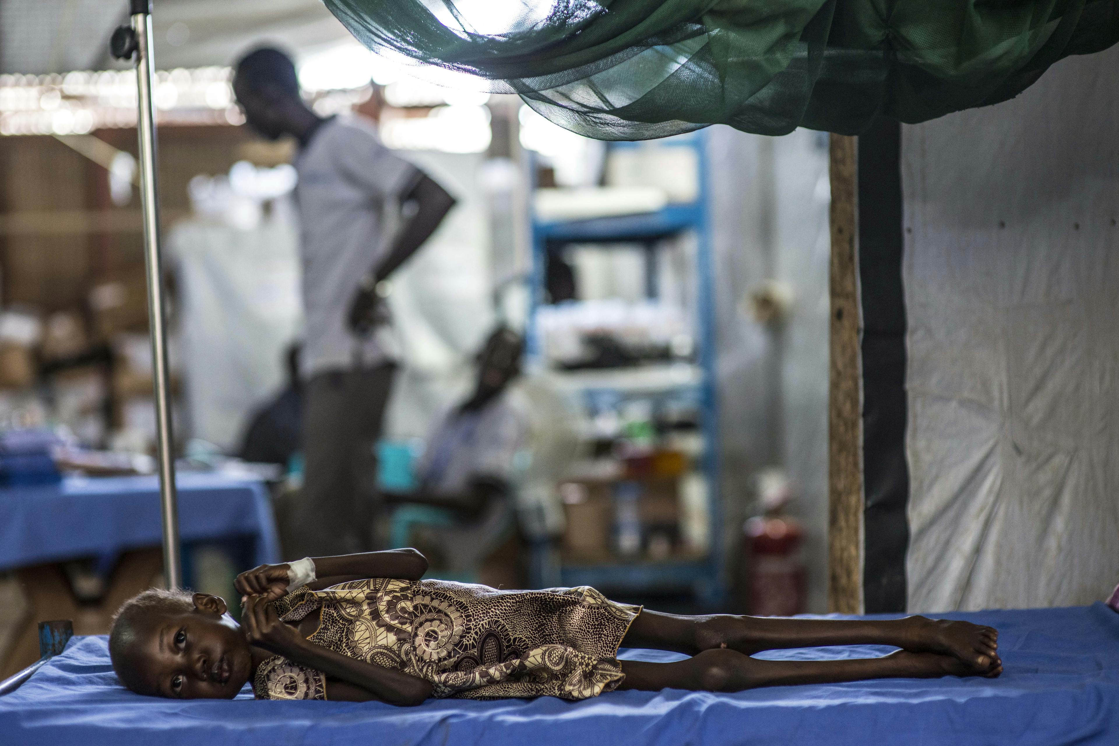 Nyajime Guet, 4, who is suffering from severe acute malnutrition and tuberculosis, lies on a bed at a UNICEF-supported clinic where she is being treated, at the Protection of Civilians (PoC) site in Juba, South Sudan, Monday, 12 October 2015. A four-year-old of her age and height should weigh 19.5 kilograms, rather than the 9 kilograms Nyajime weighs.