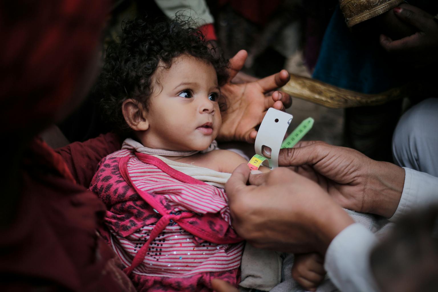 A medical practitioner uses a Mid Upper-Arm Circumference (MUAC) measuring tape on a child suffering from Severe Acute Malnutrition (SAM) in Bani Al-Harith, Sana'a, Yemen, Tuesday 14 February 2017.