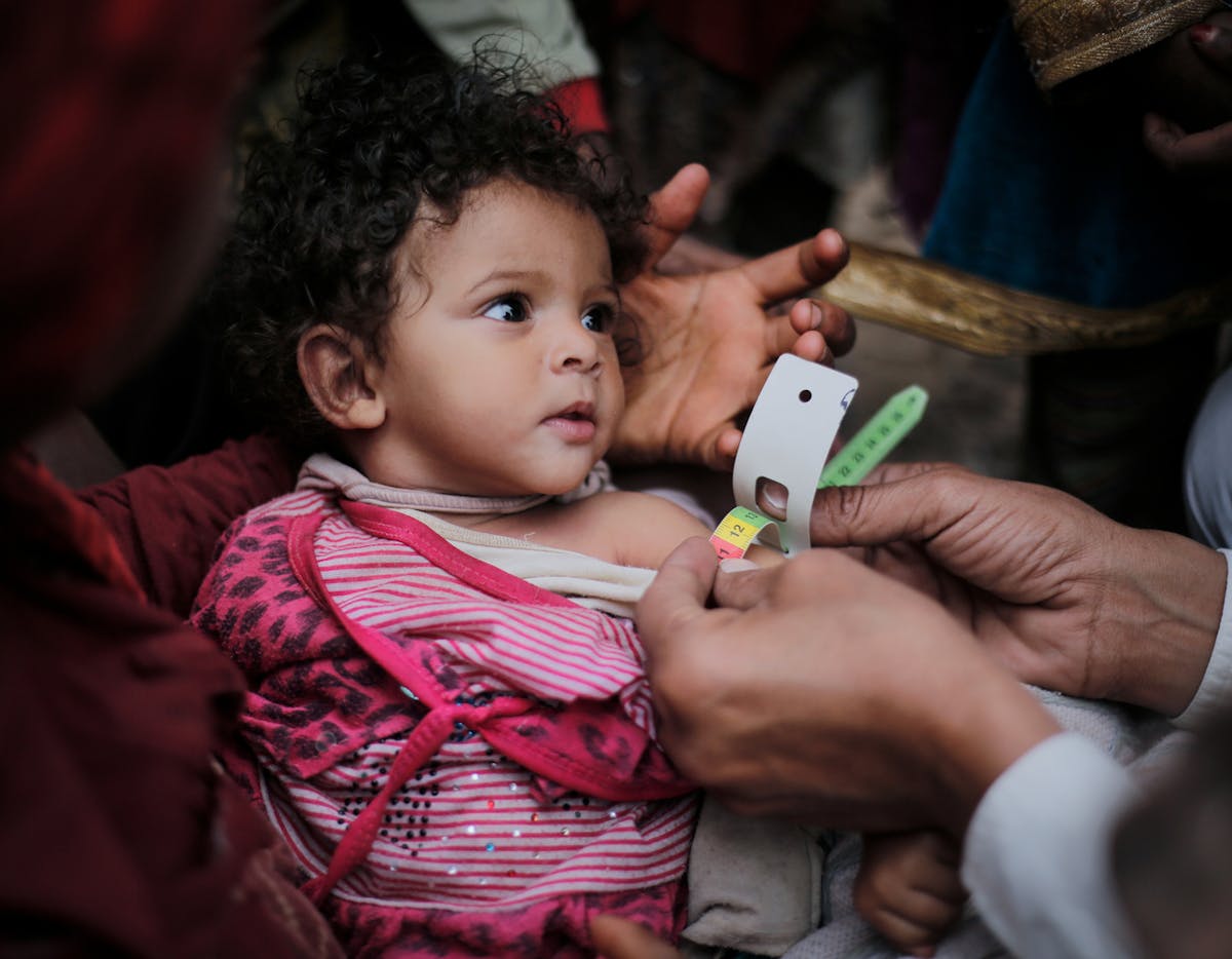 A medical practitioner uses a Mid Upper-Arm Circumference (MUAC) measuring tape on a child suffering from Severe Acute Malnutrition (SAM) in Bani Al-Harith, Sana'a, Yemen, Tuesday 14 February 2017.