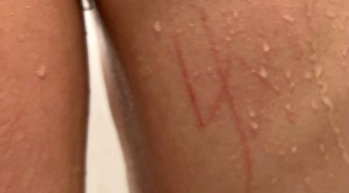 A swastika etched into the back of a US Jewish boy with special needs at a Las Vegas school