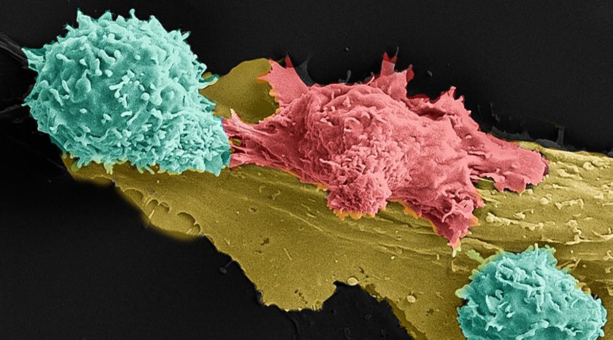 An image from the Bar Ilan University lab of Prof. Cyrille Cohen, showing two immune cells in green fighting a cancer cell in red, in the new immunotherapy invented there