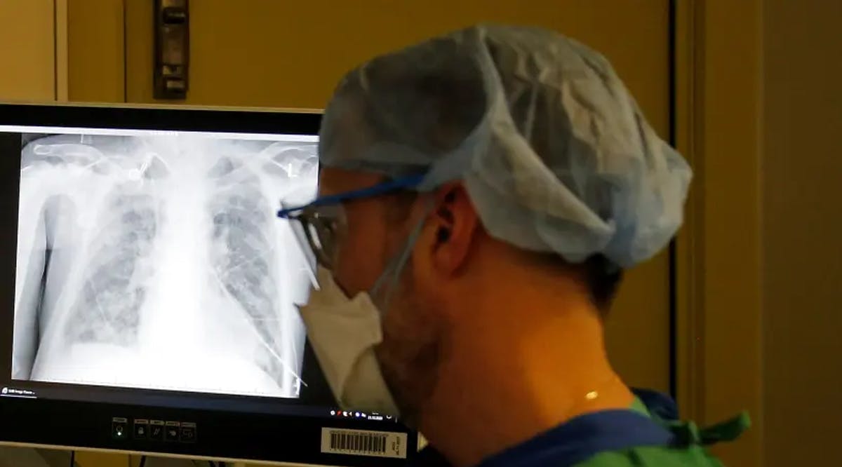 The x-ray image of the lungs of a coronavirus disease (COVID-19)