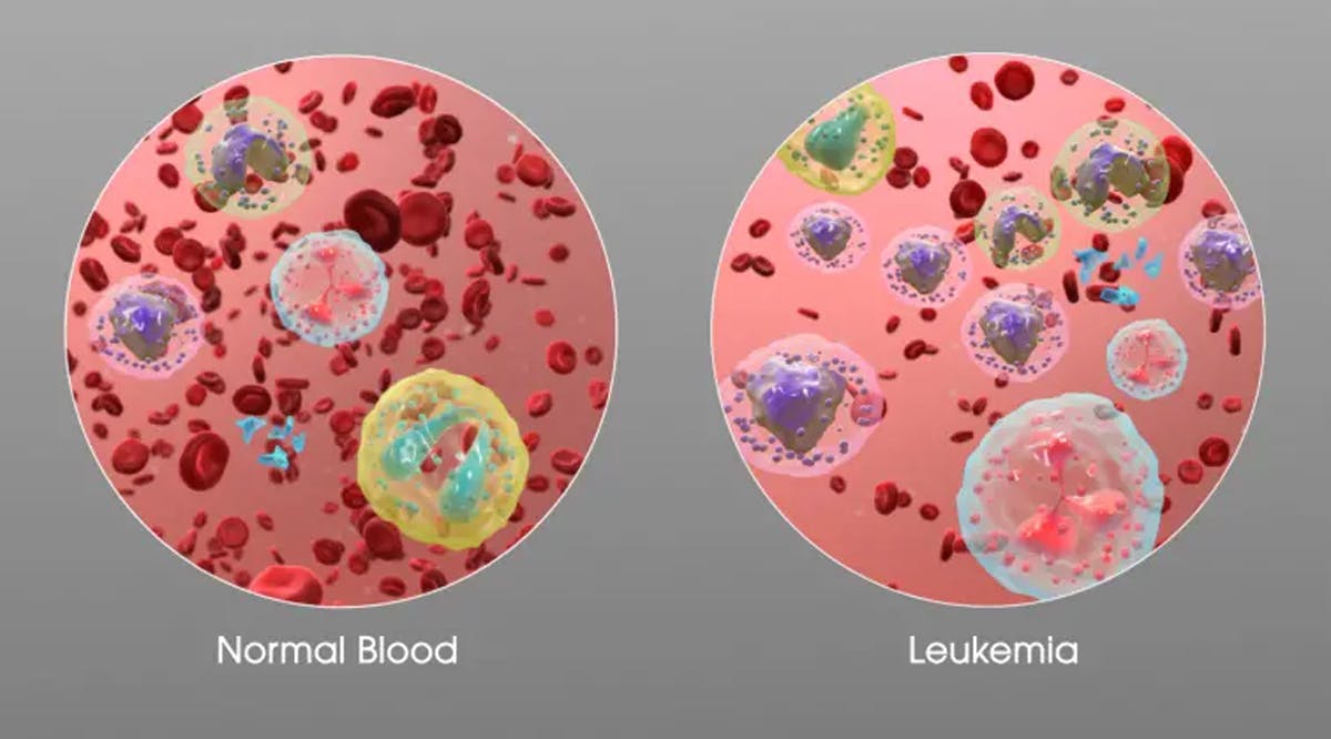 3D Medical Animation still showing an increase in white blood cells of a person suffering from Leukemia