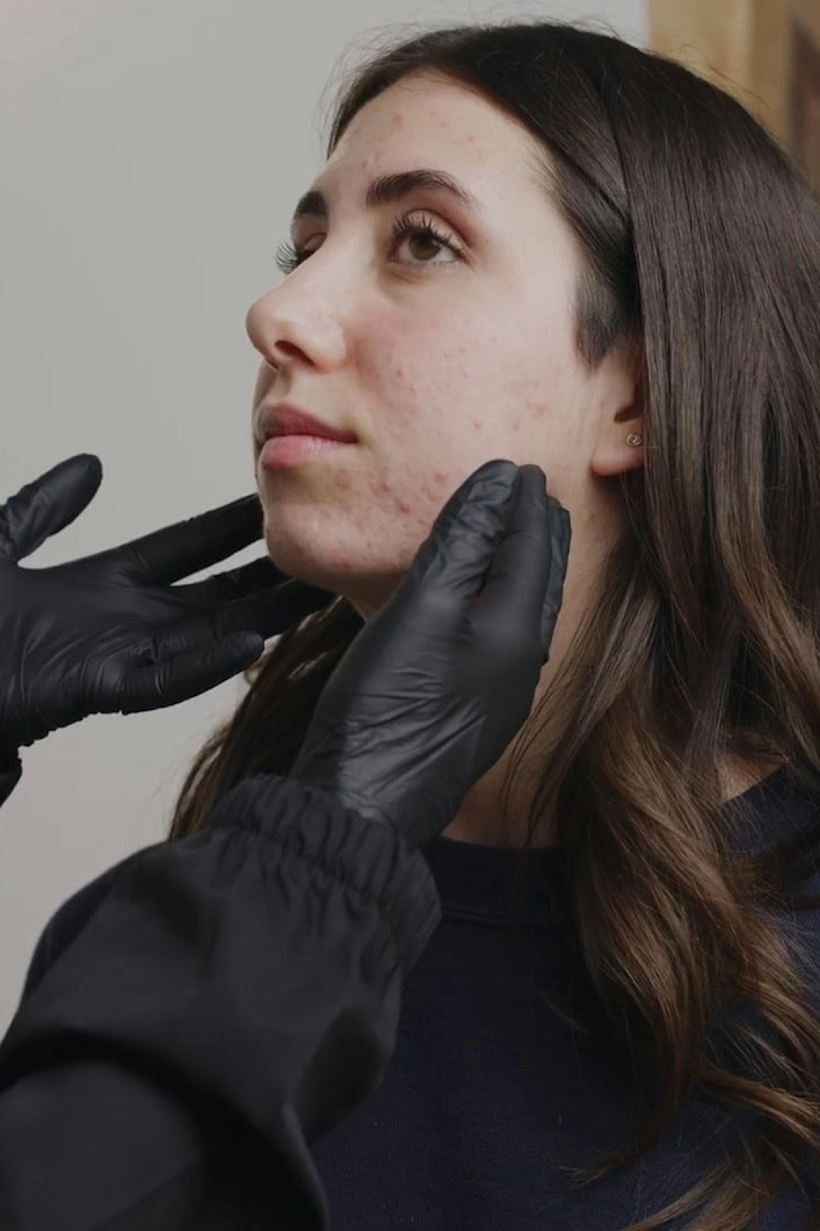controllo acne