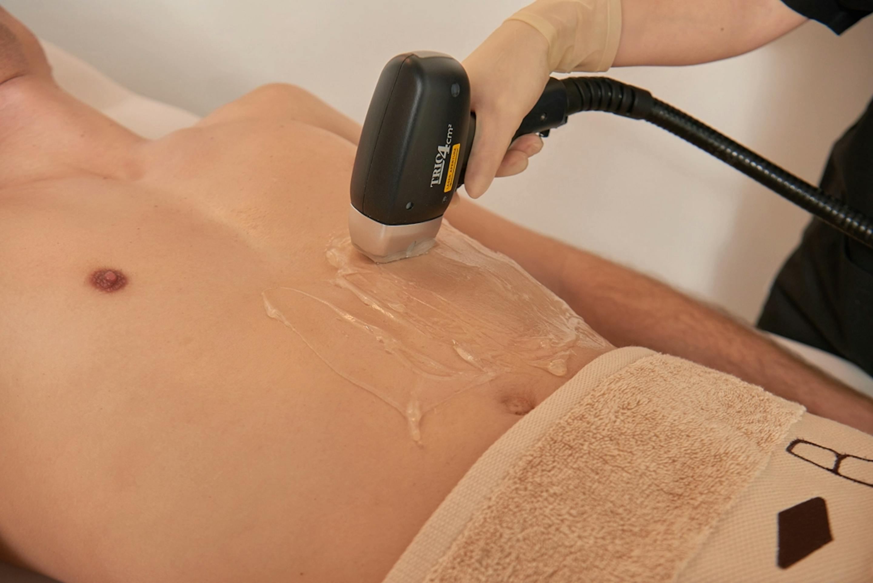 Epilazione laser