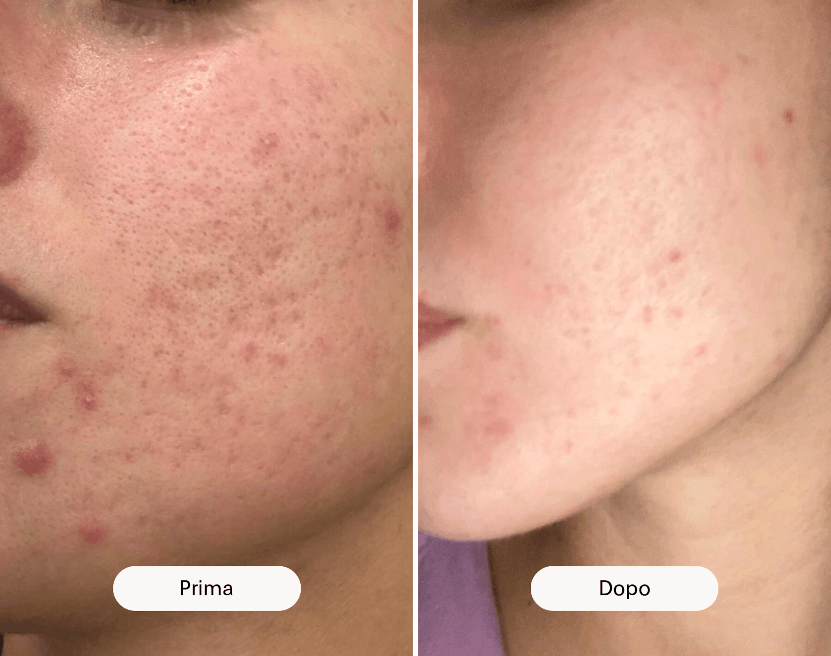 prima e dopo rimozione acne
