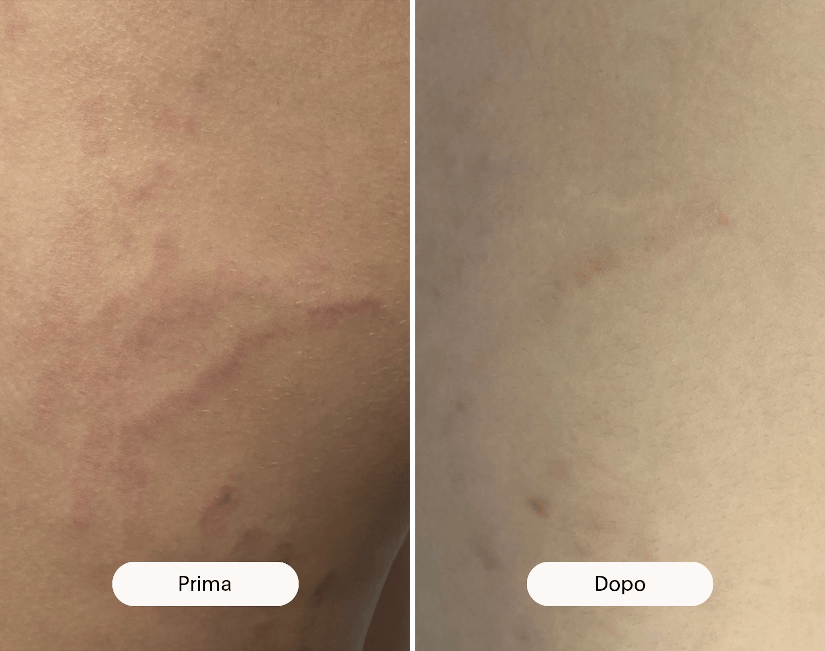 prima e dopo rimozione smagliature