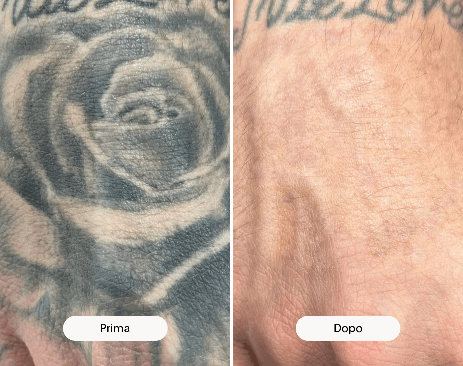 rimozione tatuaggi mano prima e dopo