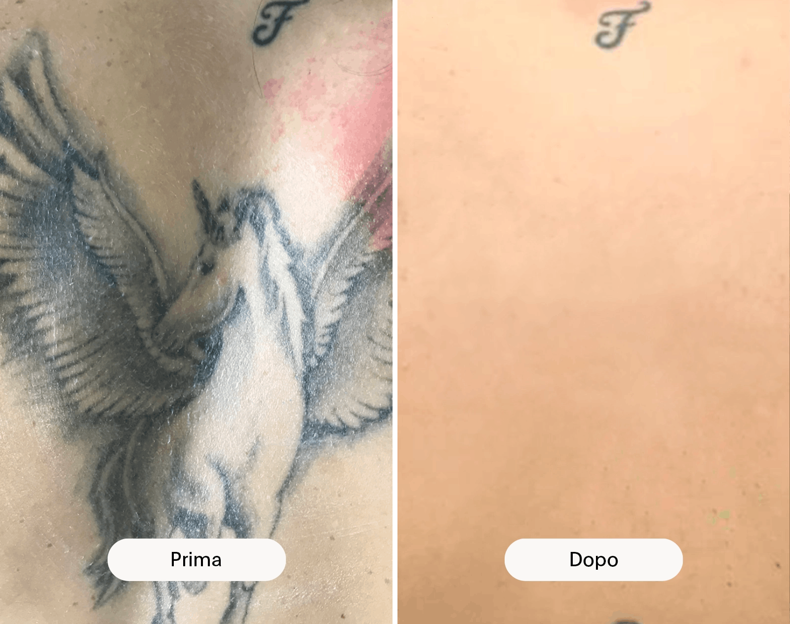 rimozione tatuaggi prima e dopo schiena