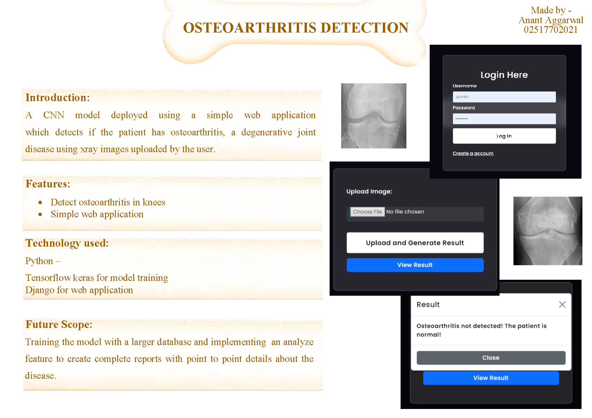 Osteoarthritis Detection