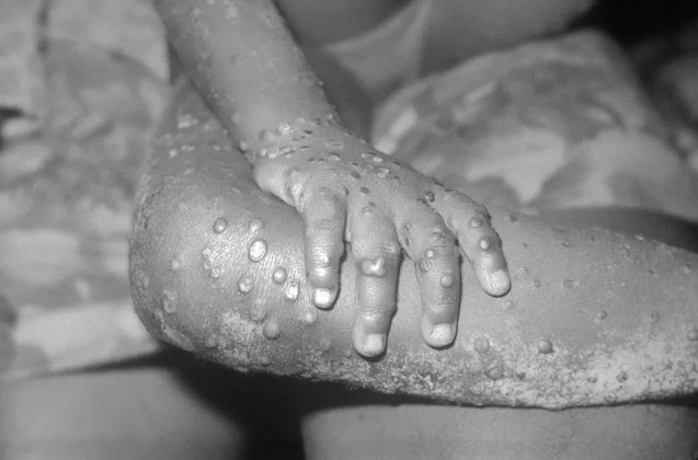 A imagem está em preto e branco, apresenta uma criança com o vírus monkeypox, com várias lesões pelo corpo. Fonte: Reprodução/R7