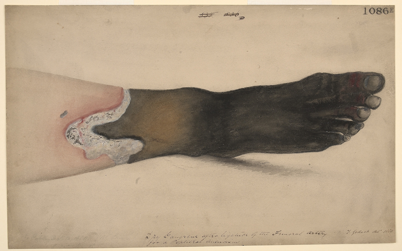 illustration showing gangrenous foot 