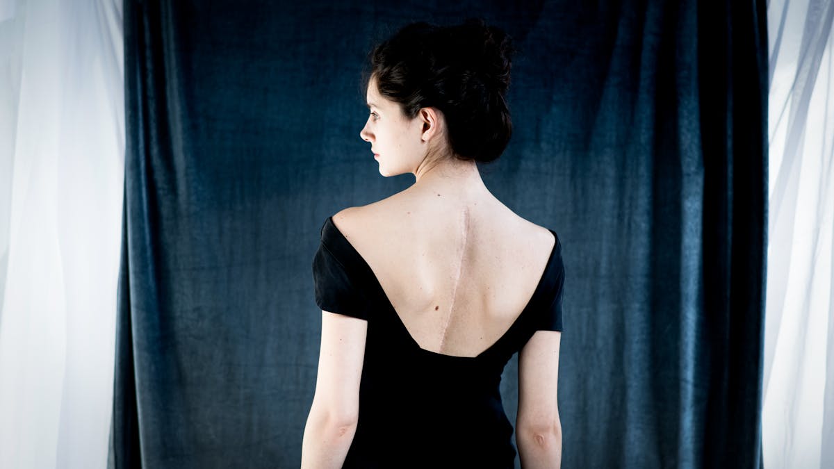 Photograph of a young woman from behind, from the waist up. Her head is turned to the left revealing her profile. She is wearing a low cut black dress which reveals a long scar following her spine. In the background are drapes of blue and white fabrics.