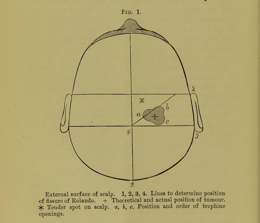 Diagram showing the location of the tumour, from the original case report of Godlee's operation from ‘Case of cerebral tumour’, 1885.