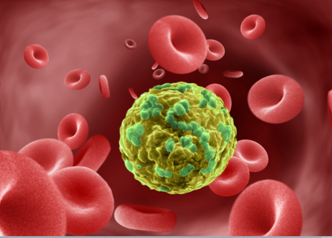 A yellow cancer cell floats against a background of red blood cells.