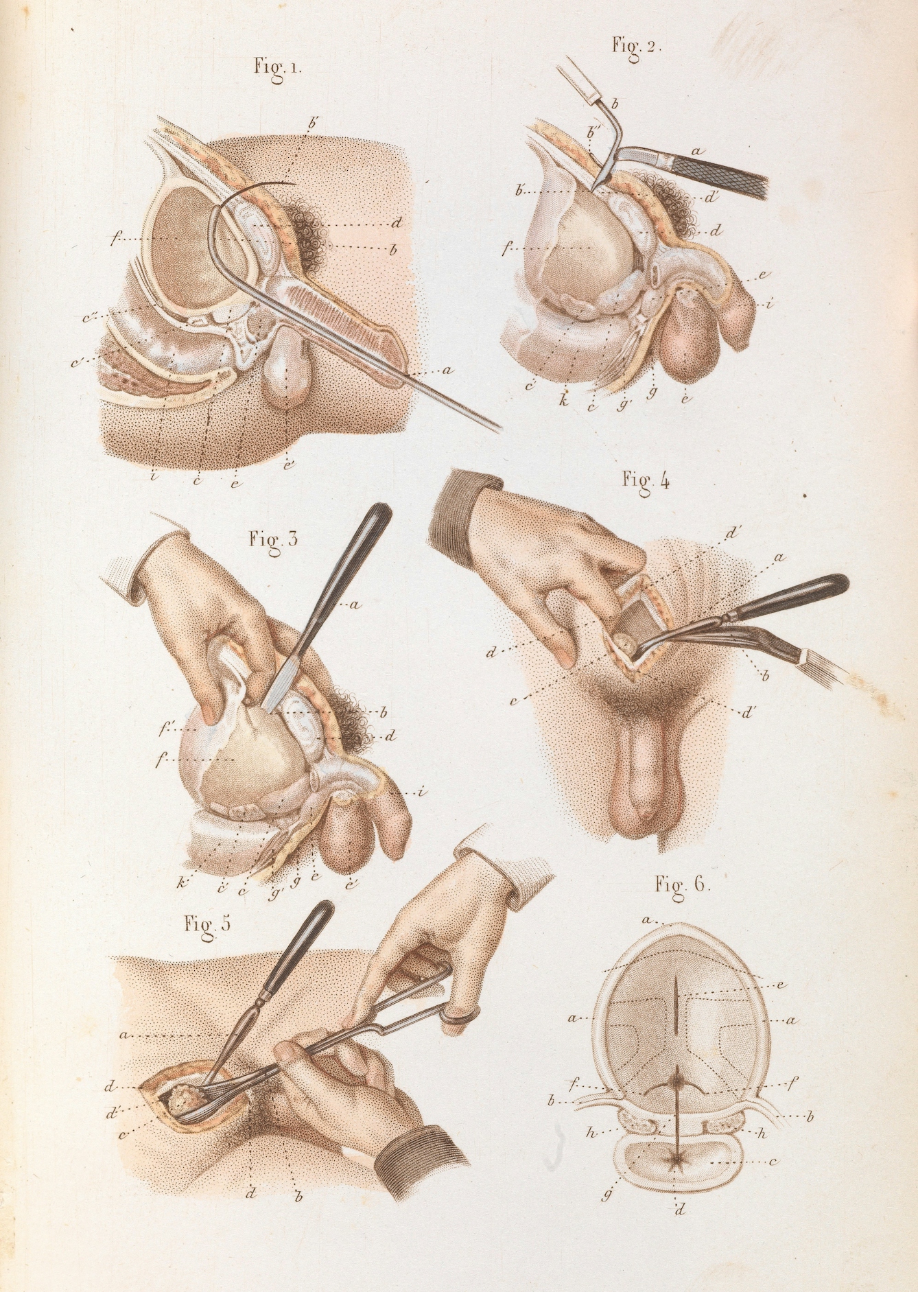 Surgical removal of a stone from the bladder from 'Précis iconographique de médecine opératoire et d'anatomie chirurgicale' by Claude Bernard, 1848 