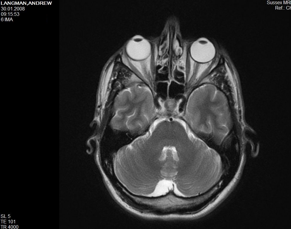 Black and white MRI scan of the human brain.