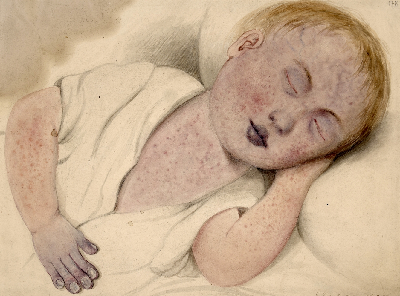 Drawing of a small child with cyanosis and measles