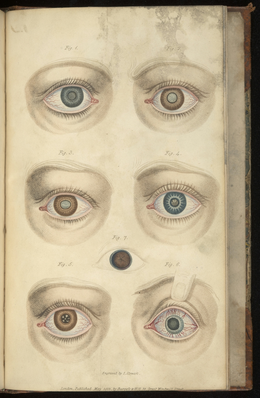 Colour engravings of problems with the eye depicting unusual irises and corneas, for instance with zig-zag lines or clouding.