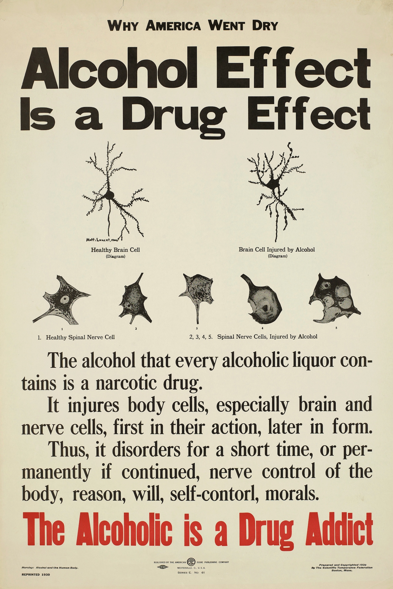 Poster showing "healthy brain cells and nerve cells" and contrasting them with those "injured by alcohol".