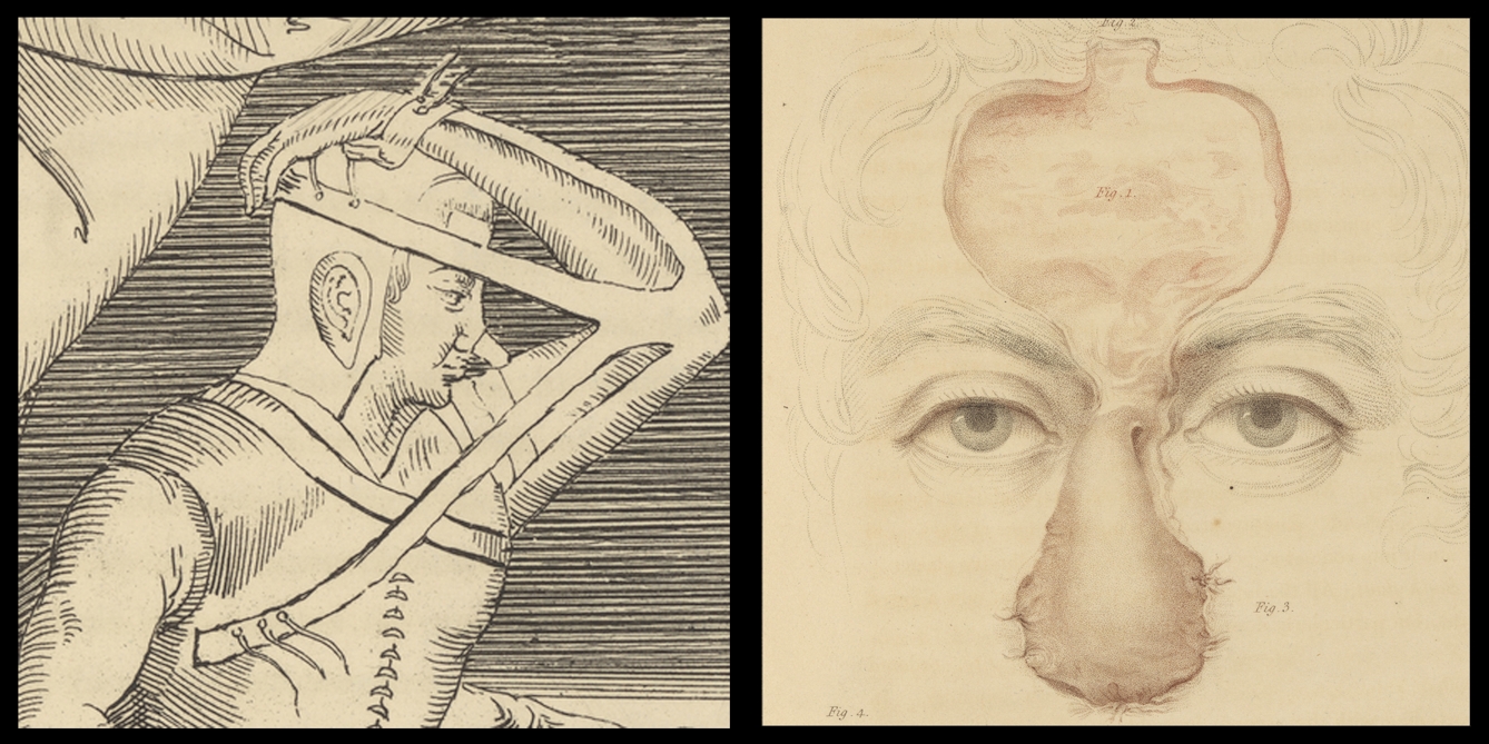 On the left a simple black-and-white line drawing depicting a man whose arm is fastened over his head and a flap of skin from his arm has been grafted onto his nose. On the left a colour engraving showing man's face with a piece of skin cut from the forehead and folded down over the nose and stitched.