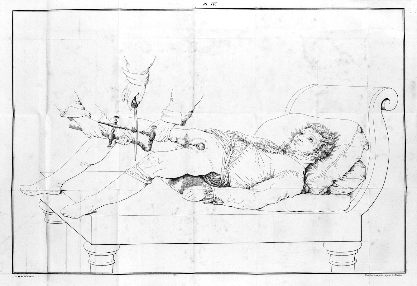 Civiale's lithotrity operation being performed